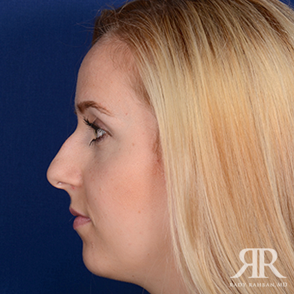 Female Rhinoplasty