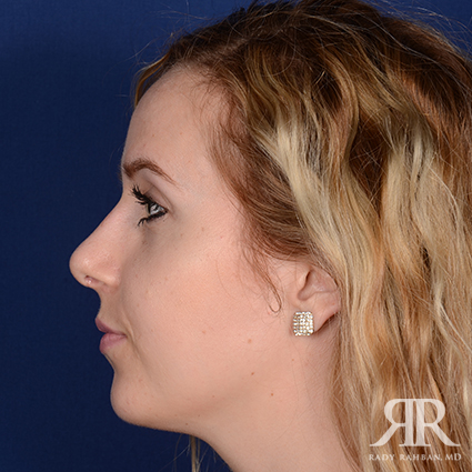 Female Rhinoplasty