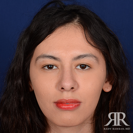 Female Rhinoplasty