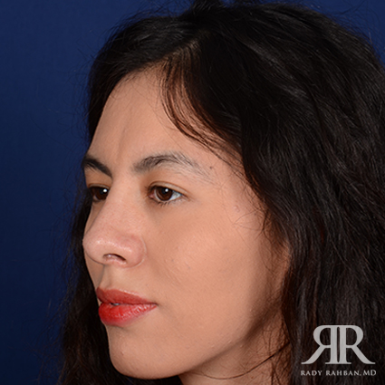 Female Rhinoplasty