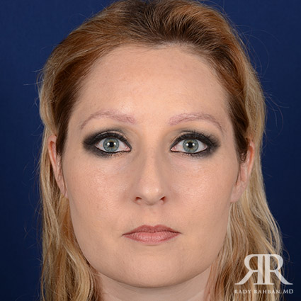 Female Rhinoplasty