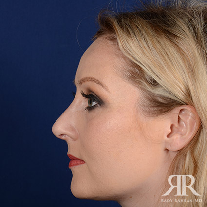 Female Rhinoplasty