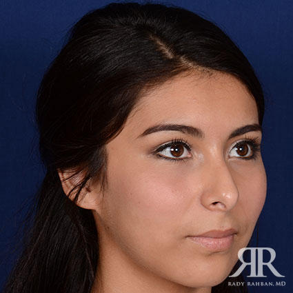 Female Rhinoplasty