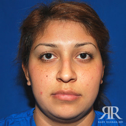 Female Rhinoplasty