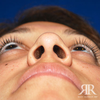 Female Rhinoplasty