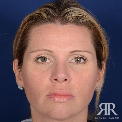 Female Rhinoplasty