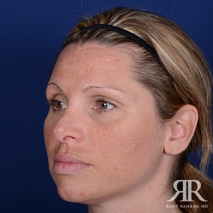 Female Rhinoplasty