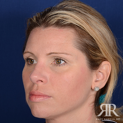 Female Rhinoplasty