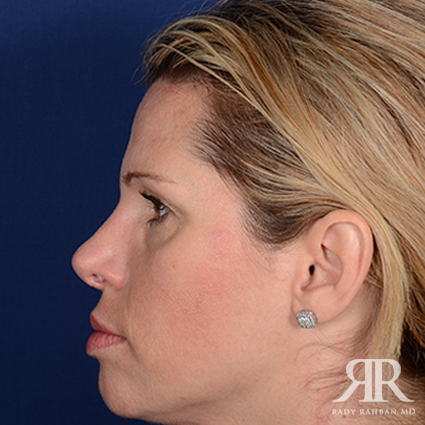 Female Rhinoplasty