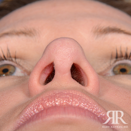 Female Rhinoplasty