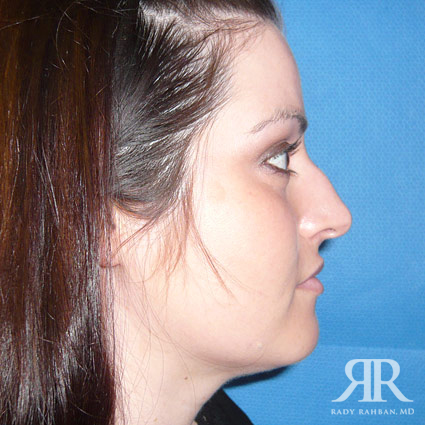 Female Rhinoplasty