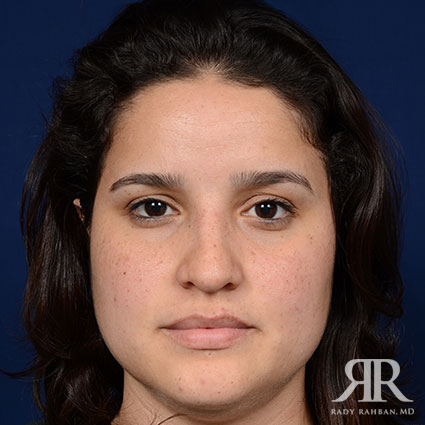 Female Rhinoplasty