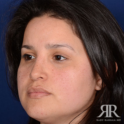 Female Rhinoplasty