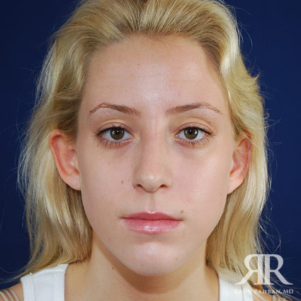 Female Rhinoplasty