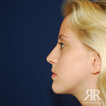 Female Rhinoplasty