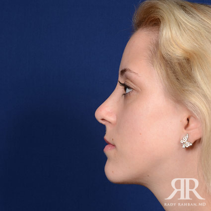 Female Rhinoplasty