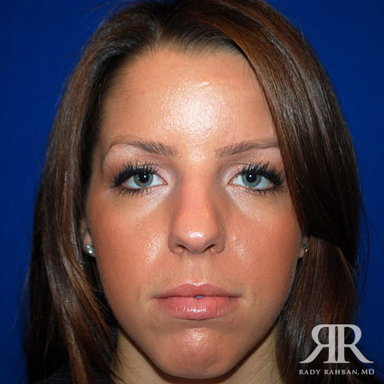 Female Rhinoplasty