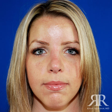 Female Rhinoplasty