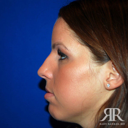 Female Rhinoplasty