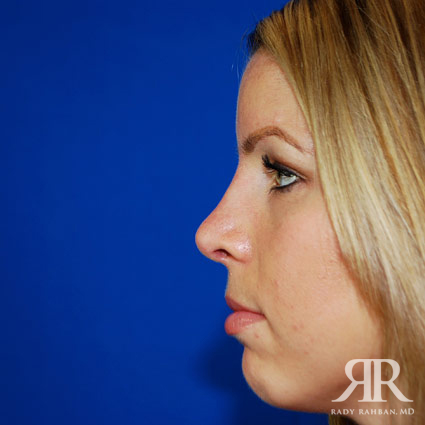 Female Rhinoplasty