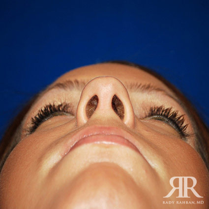 Female Rhinoplasty