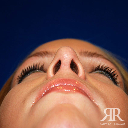 Female Rhinoplasty