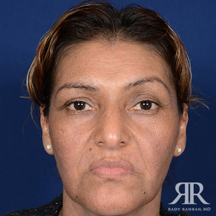 Female Rhinoplasty