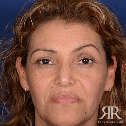 Female Rhinoplasty