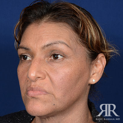 Female Rhinoplasty