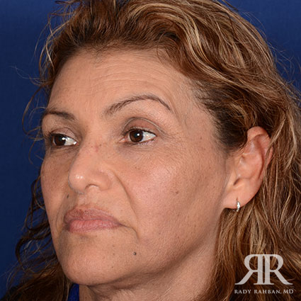 Female Rhinoplasty