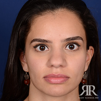 Female Rhinoplasty