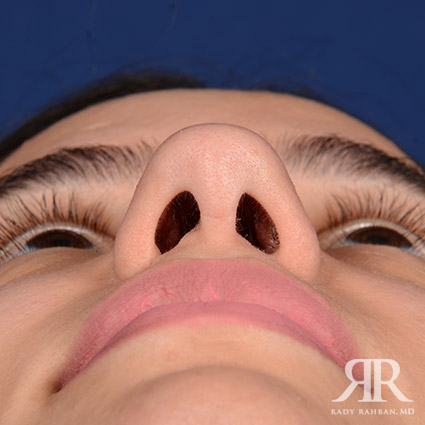 Female Rhinoplasty