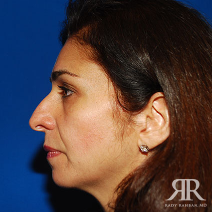 Female Rhinoplasty