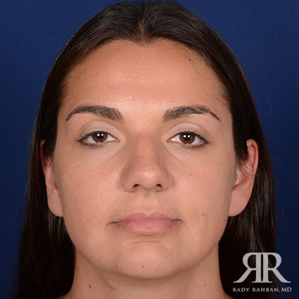 Female Rhinoplasty