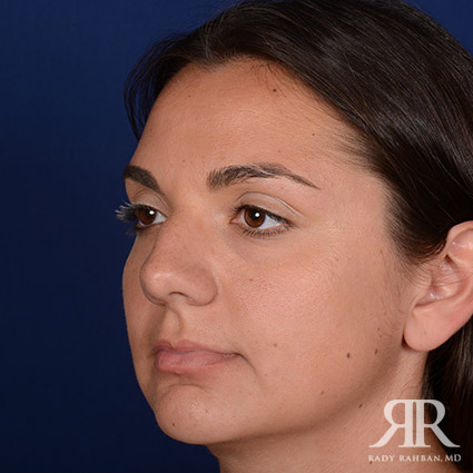 Female Rhinoplasty