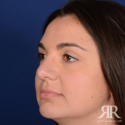 Female Rhinoplasty