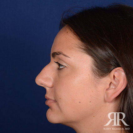 Female Rhinoplasty