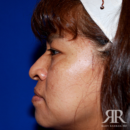 Female Rhinoplasty