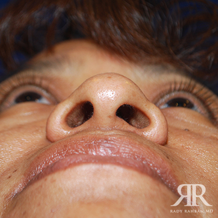 Female Rhinoplasty