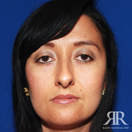 Female Rhinoplasty