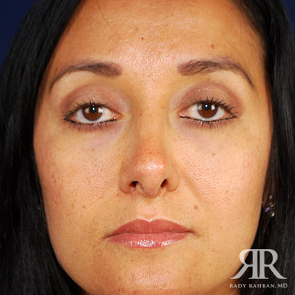 Female Rhinoplasty