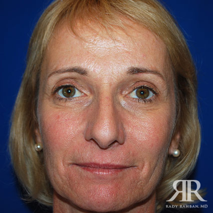 Female Rhinoplasty