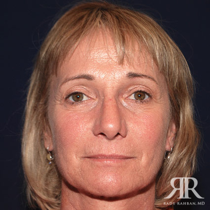 Female Rhinoplasty