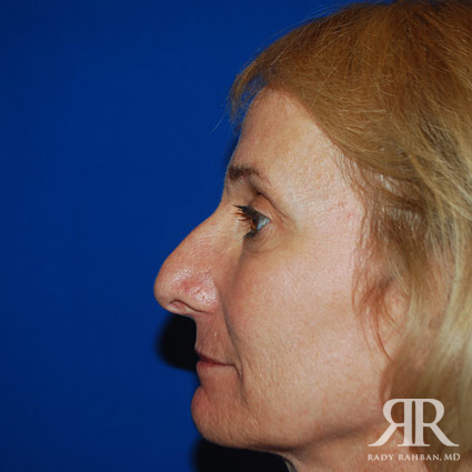 Female Rhinoplasty