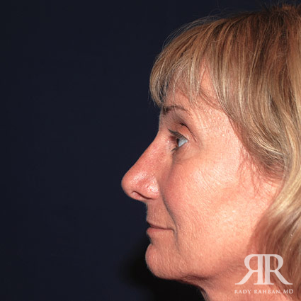 Female Rhinoplasty