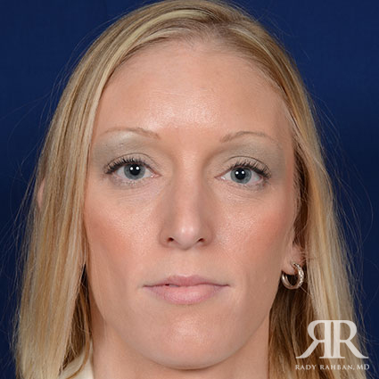 Female Rhinoplasty