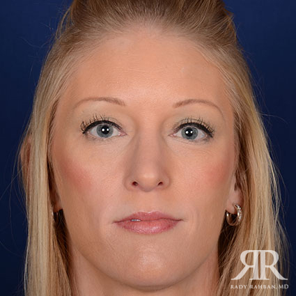 Female Rhinoplasty