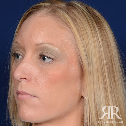 Female Rhinoplasty