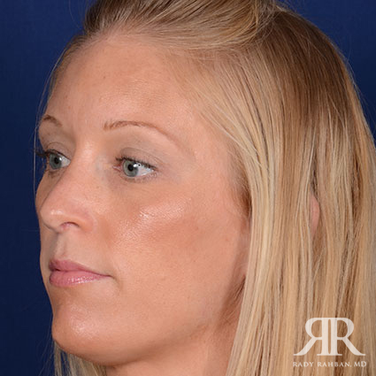 Female Rhinoplasty