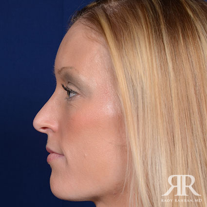 Female Rhinoplasty